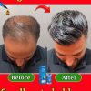 2024 Ginger Hair Growth Serum Sprayer Hair Regrowth s Grow Thicker Longer Hair Accelerate Growth For Men And Women